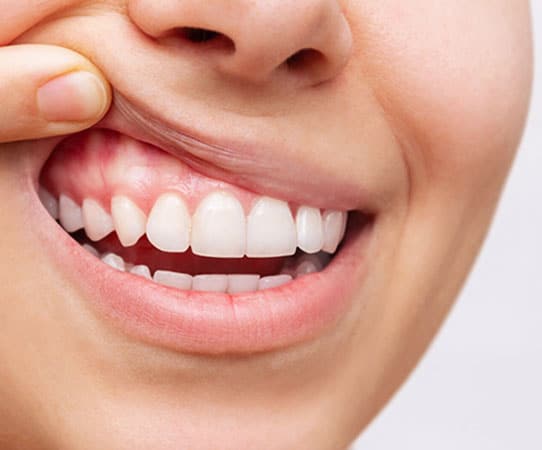 Gum Disease