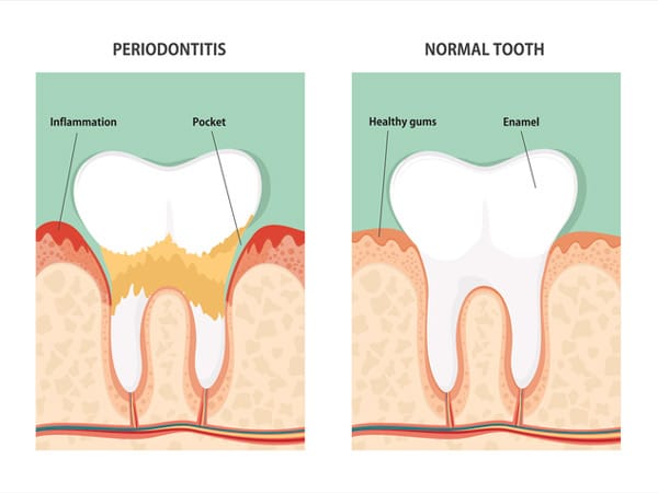 periodontal care