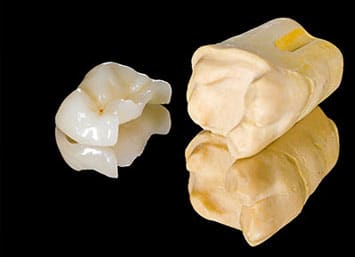 Inlays and Onlays