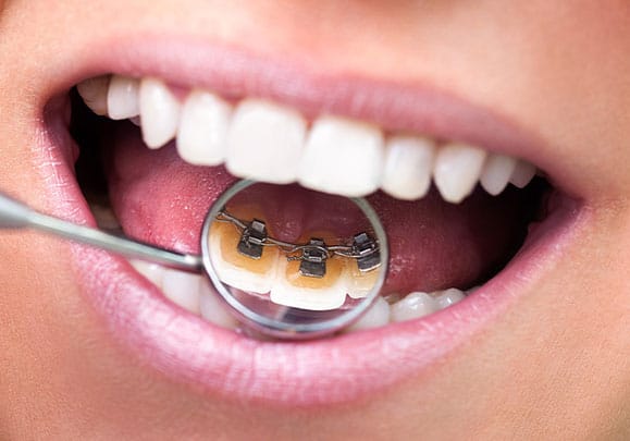 Lingual System Braces