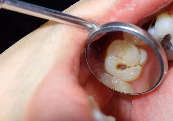 causes of tooth loss