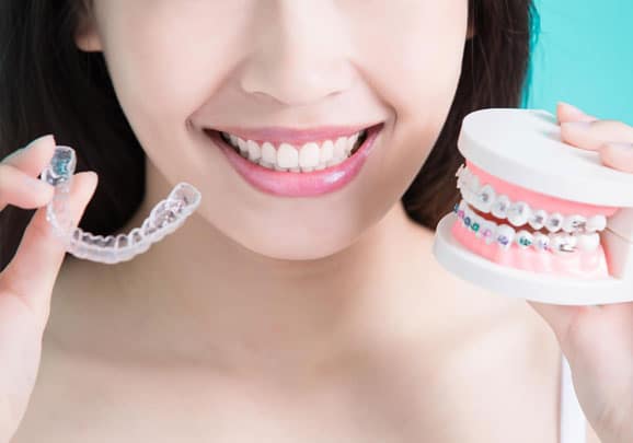 Aligners Vs Braces