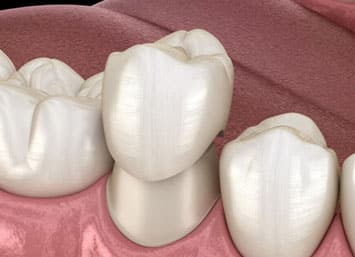 CEREC® Same-Day-Crowns
