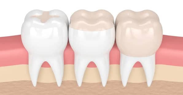 Damaged enamel