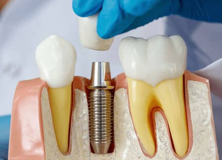 Dental Implants