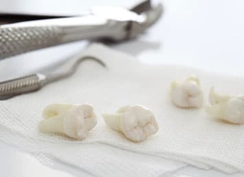 tooth Extractions