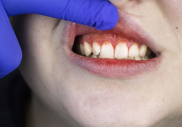 Gum disease