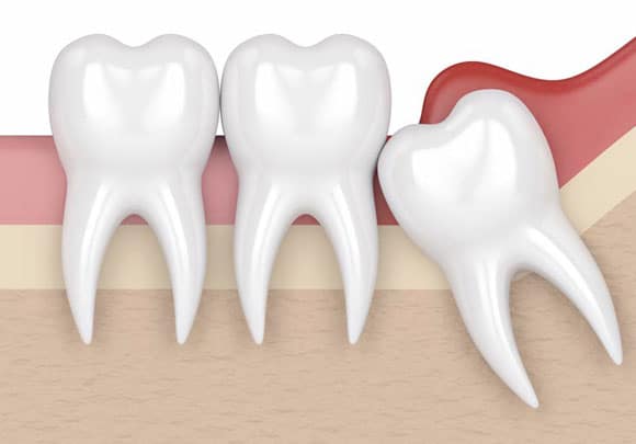 third molars