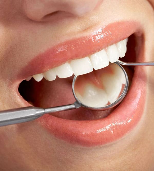 Tooth Colored Fillings