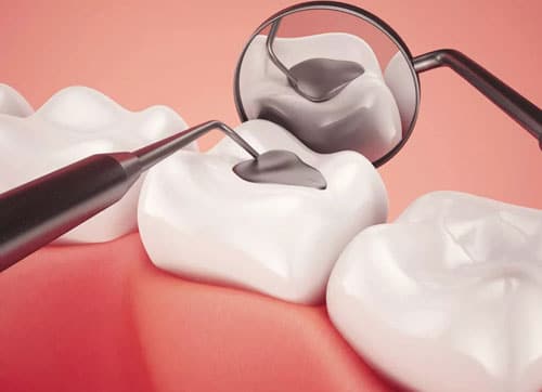 Tooth Colored Fillings