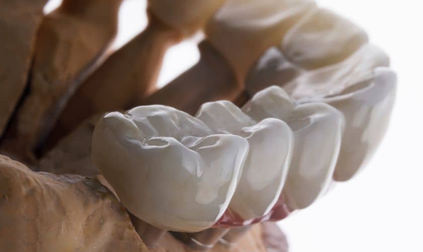 Featured image for “Dental Bridges and Oral Health: Impact on Chewing, Speaking, and Facial Structure”