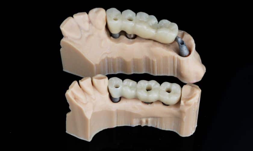 Featured image for “Caring for Your Dental Bridge: Maintenance Tips for Longevity”