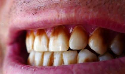 Featured image for “How to Prevent Coffee Stains on Your Teeth Without Giving Up Your Favorite Brew”