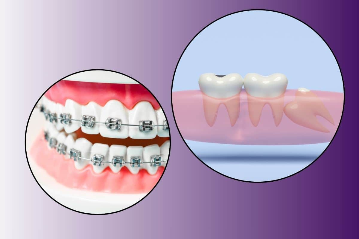 Featured image for “Braces After Wisdom Teeth Removal”