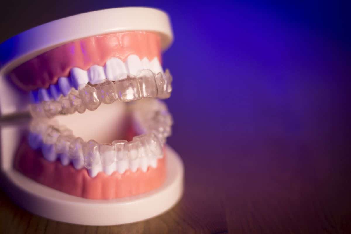 Featured image for “For How Long Do I Have To Wear Invisalign?”
