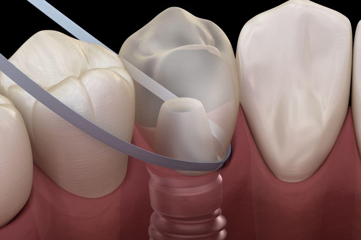 Featured image for “Do I Need to Have Dental Implants for Front Teeth?”