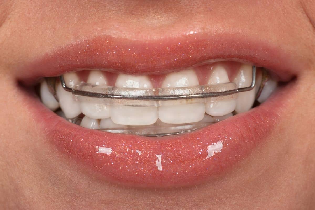 Featured image for “Retainer for Teeth Straightening”