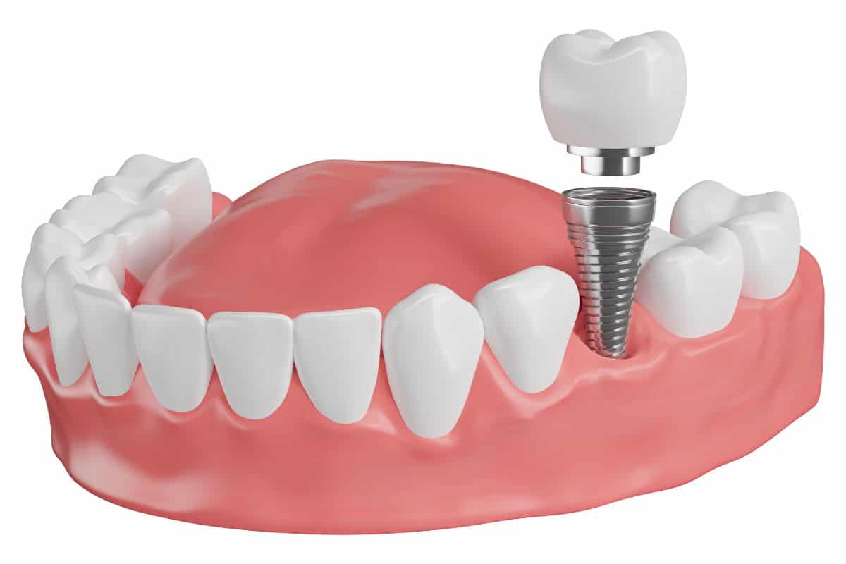 Featured image for “What to Expect Before and After Dental Implants Surgery”