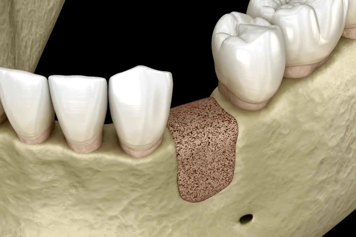 Featured image for “Bone Graft for Dental Implants – A Quick Guide”