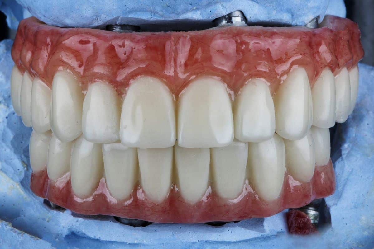 Featured image for “Bone Grafting: Process, Healing, Risks and Benefits”