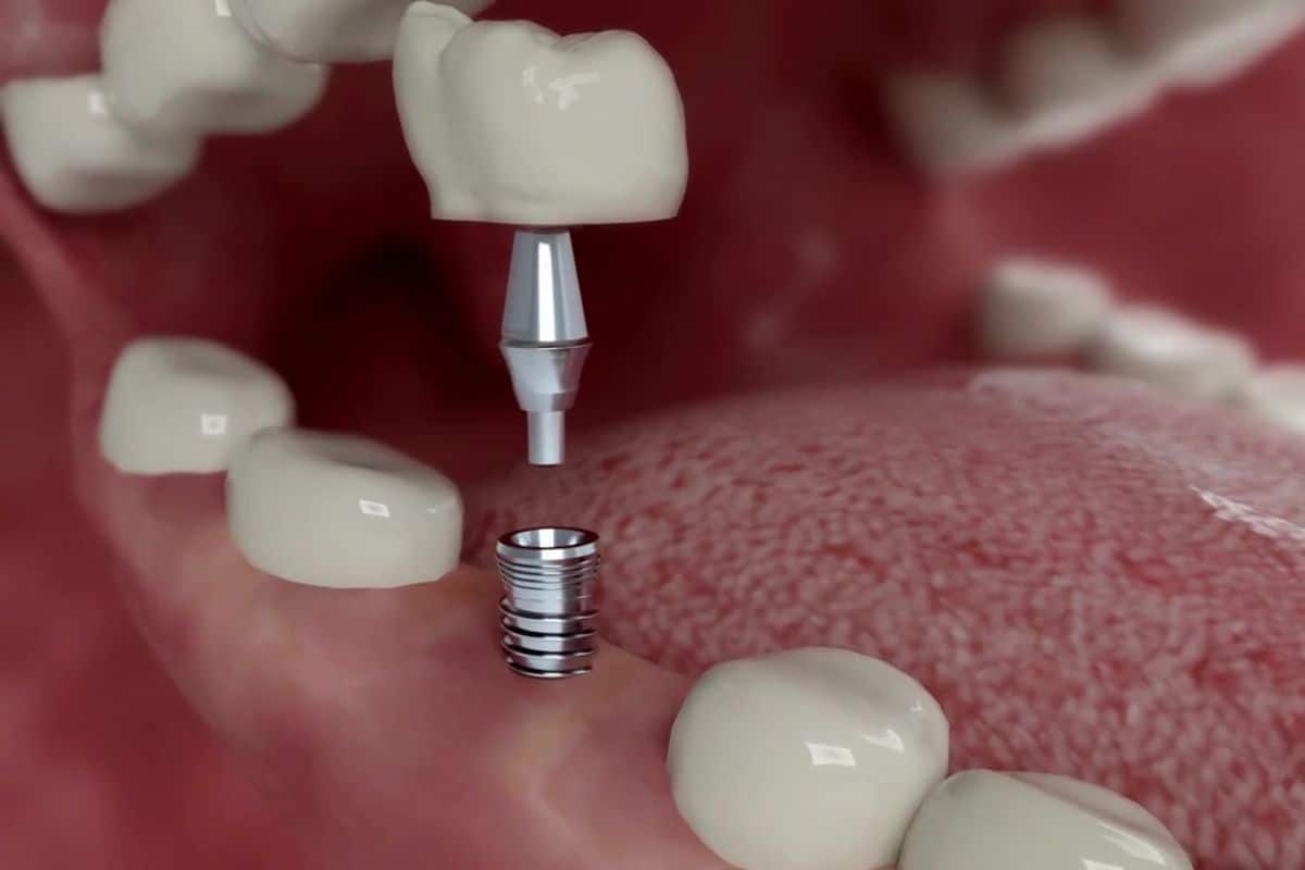 Featured image for “What Is an Implant Abutment?”