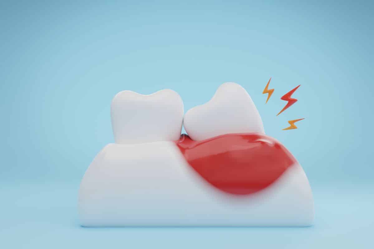 Featured image for “Why Are My Gums Swollen and Bleeding?”