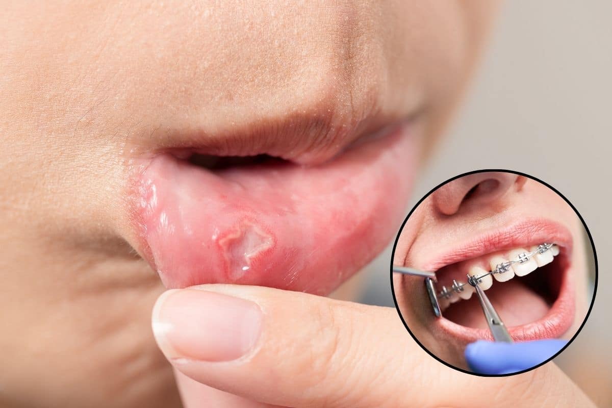 Featured image for “Dealing with Canker Sores During Orthodontic Treatment”