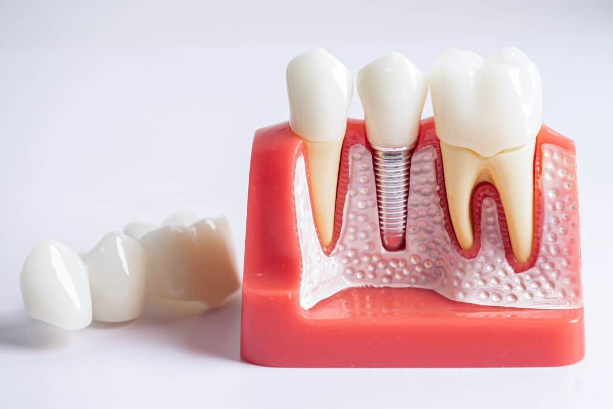 Featured image for “The Connection Between Dental Implants and Gum Disease”