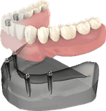 Dental implant model showing tooth replacement procedure with artificial teeth and titanium base structure.
