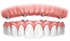 Dental implant prosthetic showing gum tissue and artificial teeth restoration model.