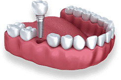 Dental implant model showing tooth replacement procedure with screw implant and crown on gum model.