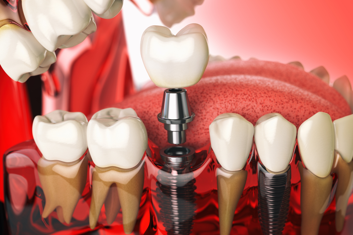 Featured image for “Transform Your Smile with Long-Lasting Dental Implant Solutions”