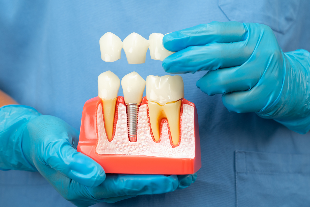 Featured image for “Why More Patients Choose Dental Implants for Permanent Tooth Replacement”