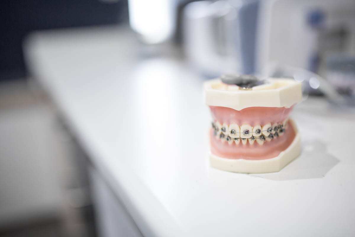 Featured image for “What Happens Inside Each Stage of Braces Treatment”